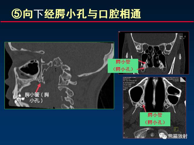 【PPT】MSCT后处理技术在显示翼腭窝解剖中的作用