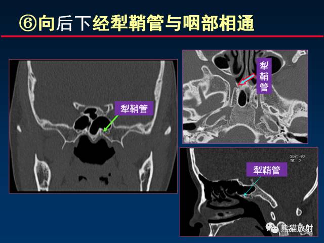 【PPT】MSCT后处理技术在显示翼腭窝解剖中的作用