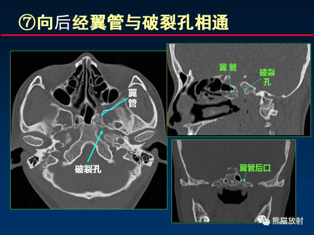 【PPT】MSCT后处理技术在显示翼腭窝解剖中的作用