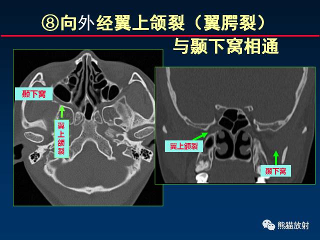 【PPT】MSCT后处理技术在显示翼腭窝解剖中的作用