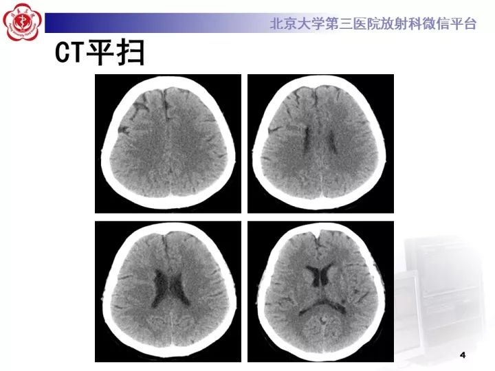 【病例】右额叶灰质异位1例CT及MR
