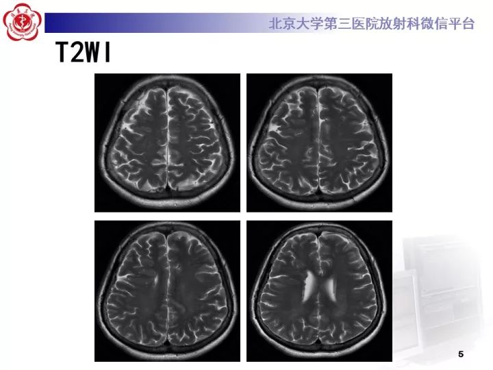 【病例】右额叶灰质异位1例CT及MR