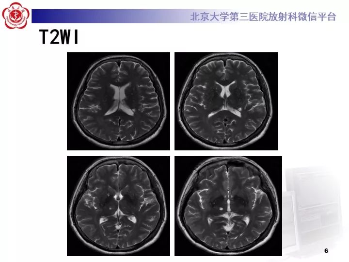 【病例】右额叶灰质异位1例CT及MR