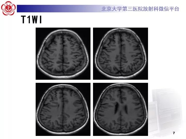 【病例】右额叶灰质异位1例CT及MR