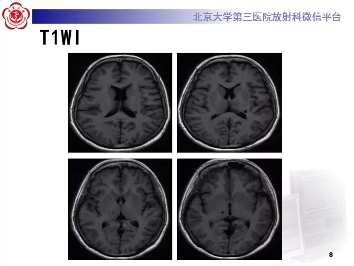 【病例】右额叶灰质异位1例CT及MR