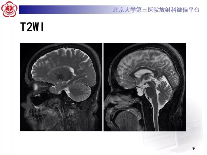 【病例】右额叶灰质异位1例CT及MR
