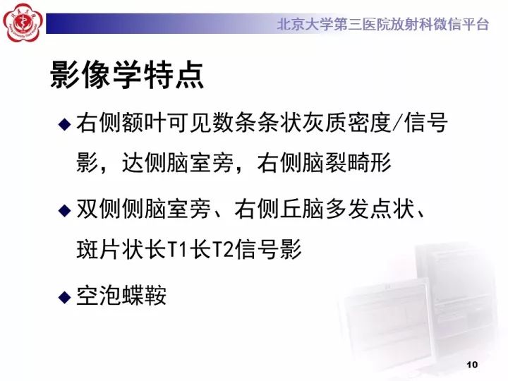【病例】右额叶灰质异位1例CT及MR