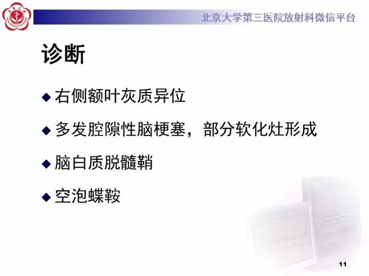 【病例】右额叶灰质异位1例CT及MR