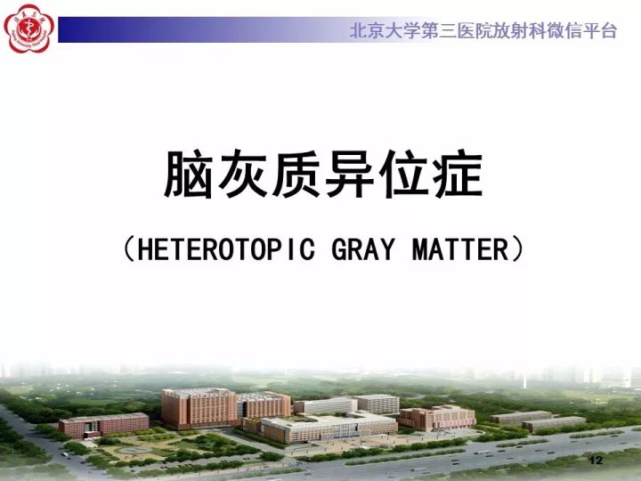 【病例】右额叶灰质异位1例CT及MR