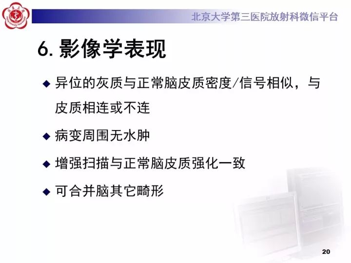【病例】右额叶灰质异位1例CT及MR