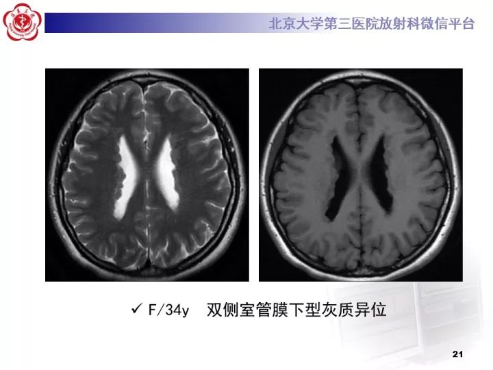 【病例】右额叶灰质异位1例CT及MR