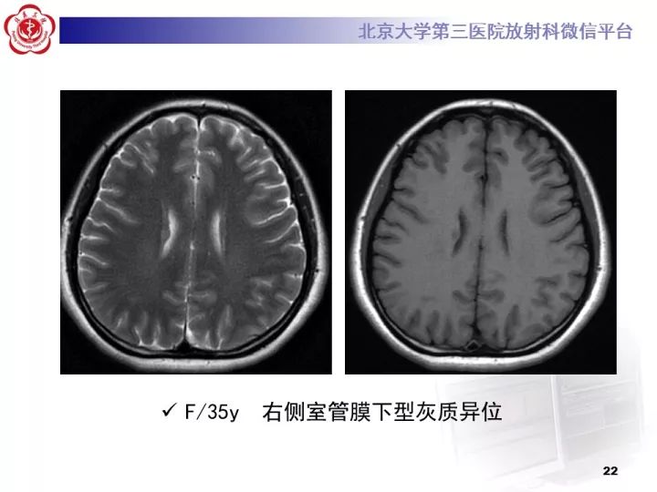 【病例】右额叶灰质异位1例CT及MR