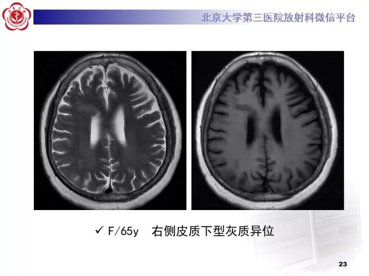 【病例】右额叶灰质异位1例CT及MR