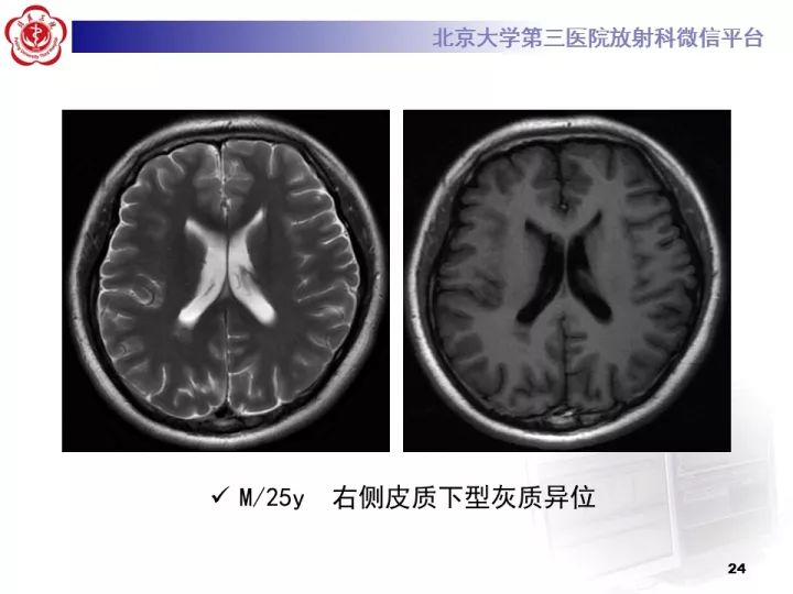 【病例】右额叶灰质异位1例CT及MR