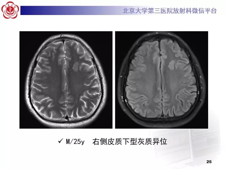 【病例】右额叶灰质异位1例CT及MR
