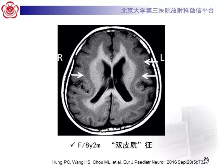 【病例】右额叶灰质异位1例CT及MR