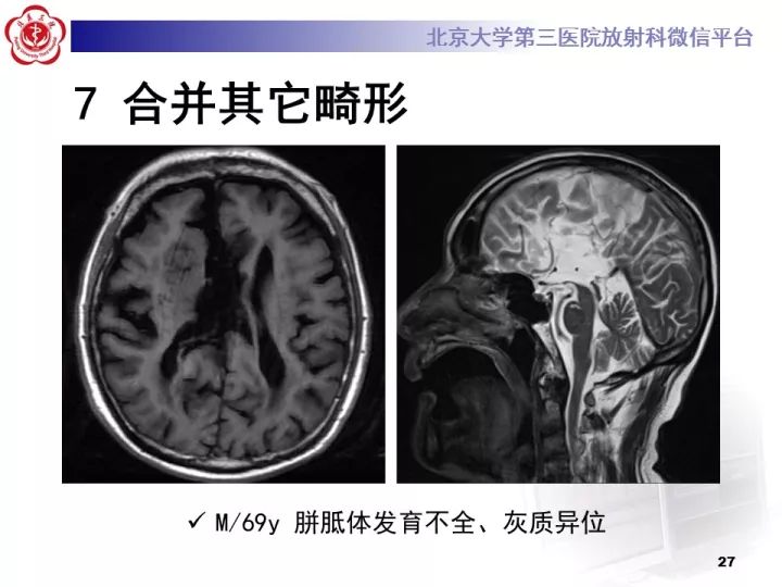 【病例】右额叶灰质异位1例CT及MR