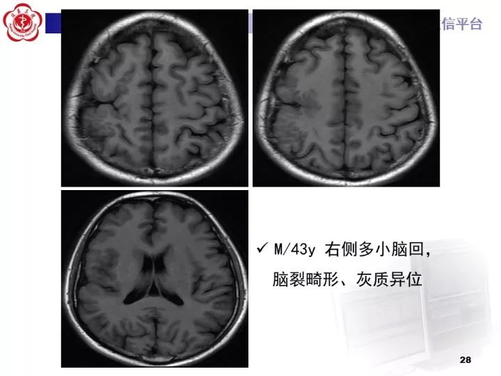 【病例】右额叶灰质异位1例CT及MR