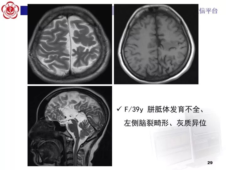 【病例】右额叶灰质异位1例CT及MR