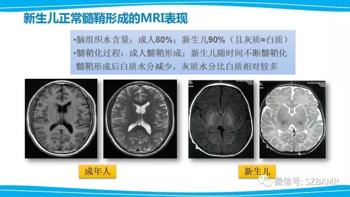 【PPT】新生儿缺氧缺血性脑病（HIE）的MRI诊断