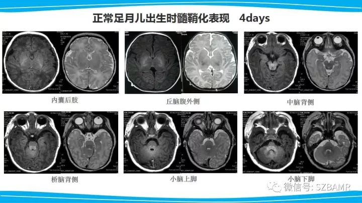 【PPT】新生儿缺氧缺血性脑病（HIE）的MRI诊断