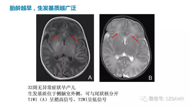 【PPT】新生儿缺氧缺血性脑病（HIE）的MRI诊断