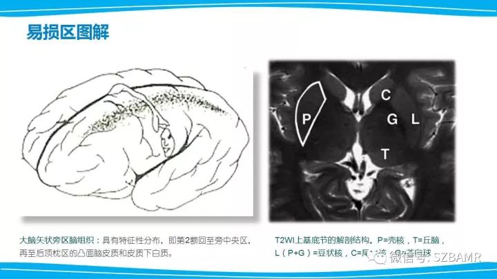 【PPT】新生儿缺氧缺血性脑病（HIE）的MRI诊断