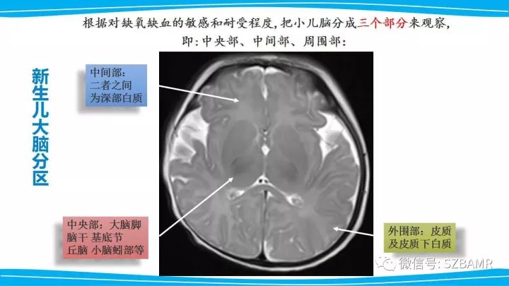 【PPT】新生儿缺氧缺血性脑病（HIE）的MRI诊断