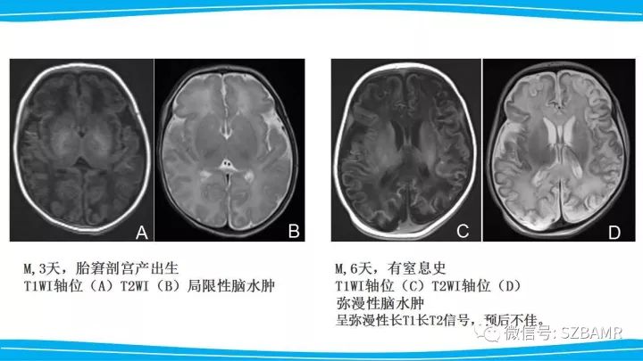 【PPT】新生儿缺氧缺血性脑病（HIE）的MRI诊断