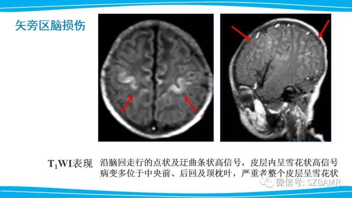 【PPT】新生儿缺氧缺血性脑病（HIE）的MRI诊断