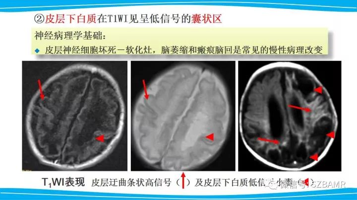 【PPT】新生儿缺氧缺血性脑病（HIE）的MRI诊断