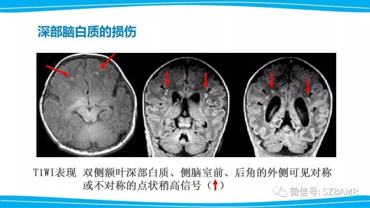 【PPT】新生儿缺氧缺血性脑病（HIE）的MRI诊断
