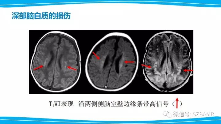 【PPT】新生儿缺氧缺血性脑病（HIE）的MRI诊断