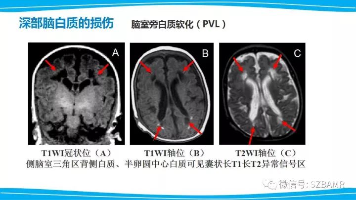 【PPT】新生儿缺氧缺血性脑病（HIE）的MRI诊断