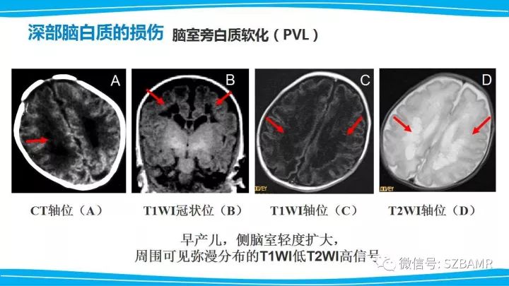 【PPT】新生儿缺氧缺血性脑病（HIE）的MRI诊断