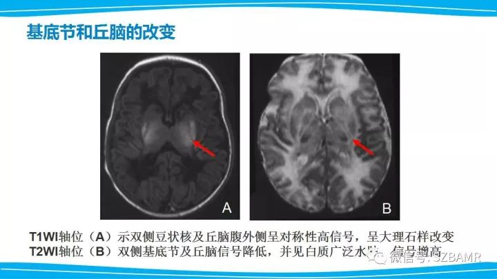 【PPT】新生儿缺氧缺血性脑病（HIE）的MRI诊断