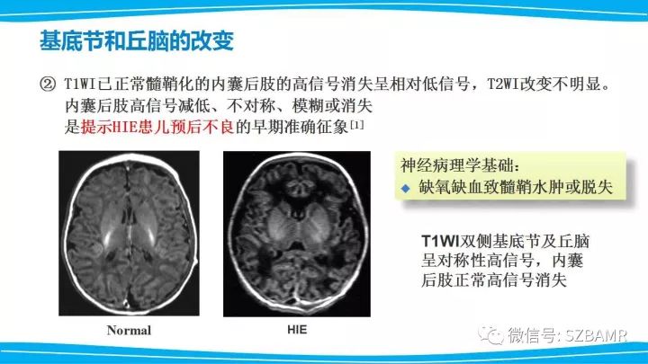 【PPT】新生儿缺氧缺血性脑病（HIE）的MRI诊断