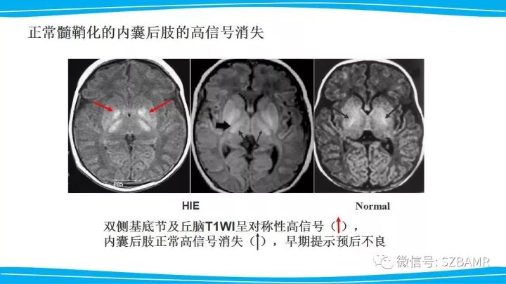 【PPT】新生儿缺氧缺血性脑病（HIE）的MRI诊断