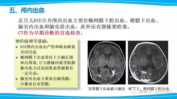 【PPT】新生儿缺氧缺血性脑病（HIE）的MRI诊断