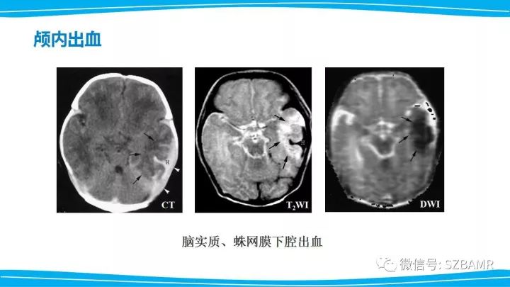 【PPT】新生儿缺氧缺血性脑病（HIE）的MRI诊断