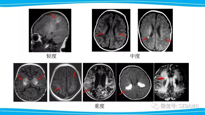【PPT】新生儿缺氧缺血性脑病（HIE）的MRI诊断