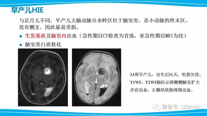 【PPT】新生儿缺氧缺血性脑病（HIE）的MRI诊断