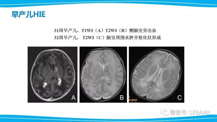 【PPT】新生儿缺氧缺血性脑病（HIE）的MRI诊断