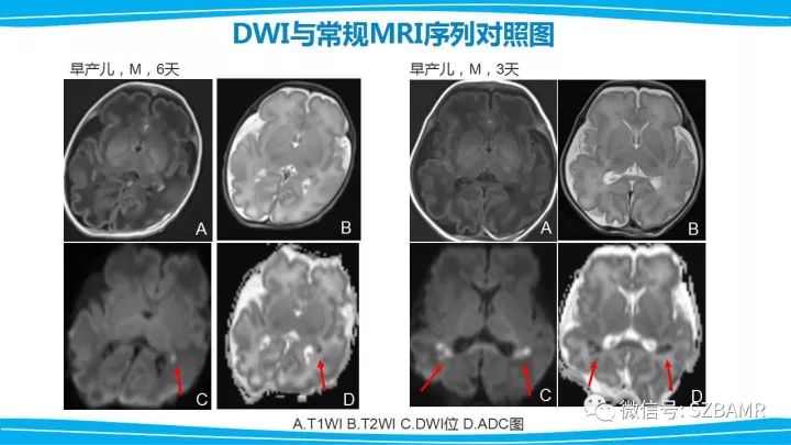 【PPT】新生儿缺氧缺血性脑病（HIE）的MRI诊断