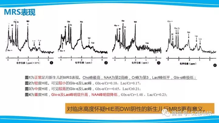 【PPT】新生儿缺氧缺血性脑病（HIE）的MRI诊断