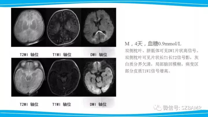【PPT】新生儿缺氧缺血性脑病（HIE）的MRI诊断