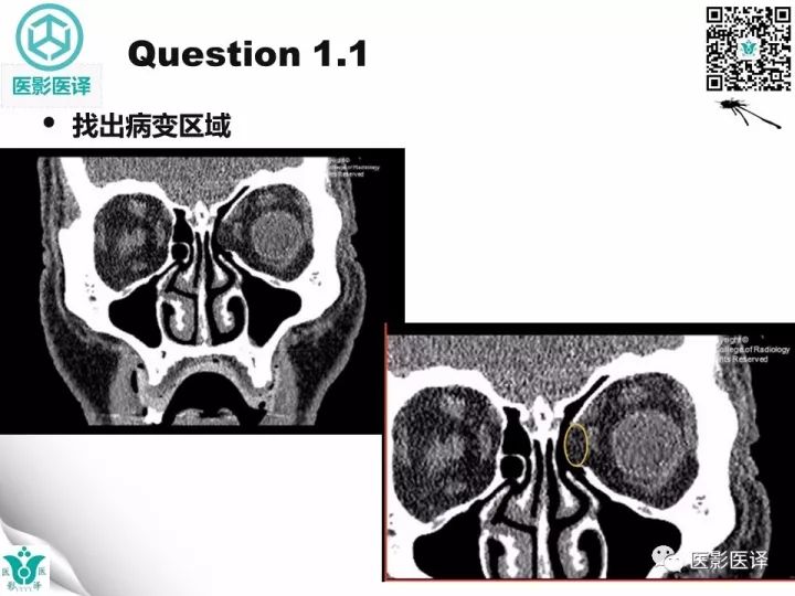 【病例】眶板断裂1例CT影像表现