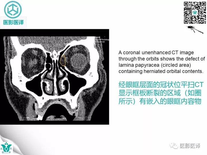 【病例】眶板断裂1例CT影像表现