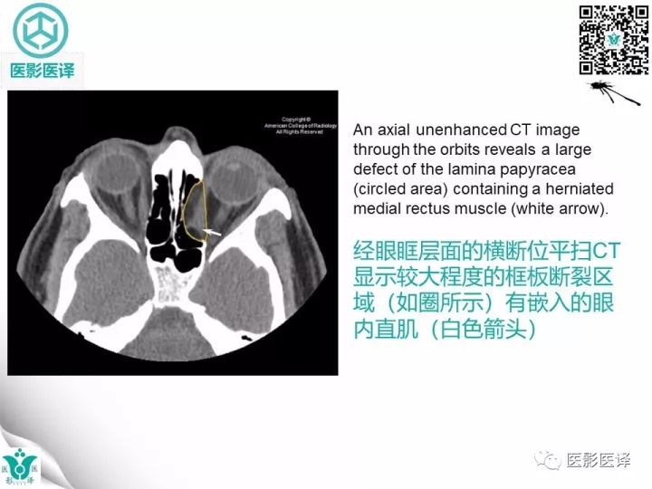 【病例】眶板断裂1例CT影像表现