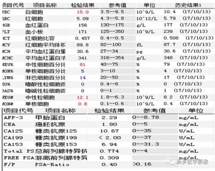 【病例】腮腺多形性腺瘤1例CT影像表现